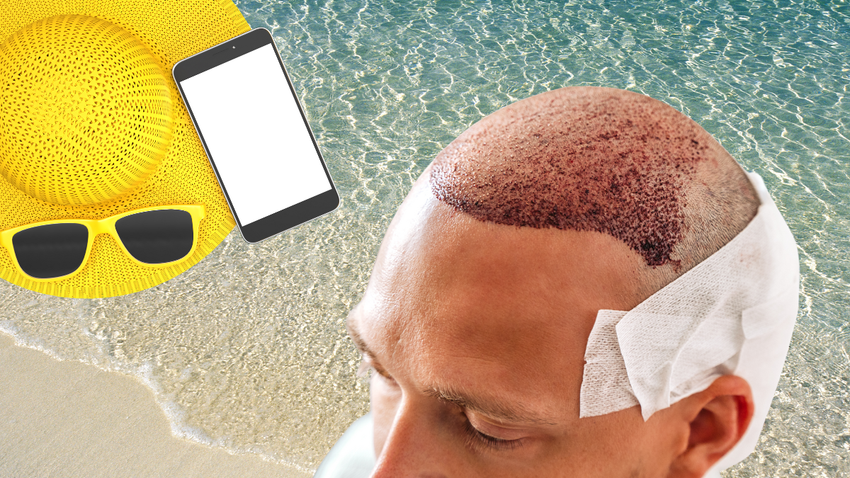 Injerto capilar en verano: ¿es buena idea? Diseno sin titulo 26 1 trasplante capilar verano