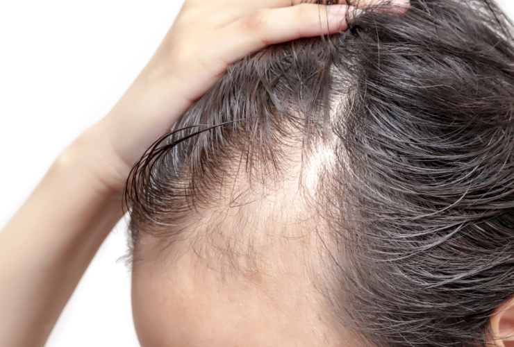 Alopecia frontal fibrosante sintomas