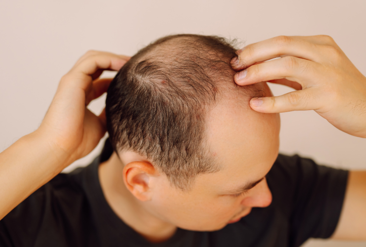 Alopecia androgénica: cómo identificarla, frenarla y diferenciarla Diseno sin titulo 5 1 9 alopecia androgénica como diferenciar